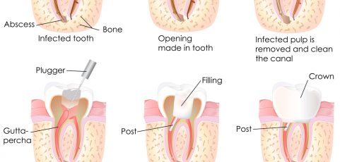 Root Canal Treatment: What to expect | General Dentistry in Richmond BC