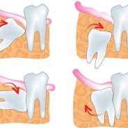 Wisdom teeth | Dr. Oliveros, Dentist in Richmond, BC